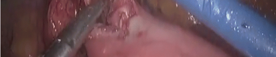 submucosa anastomosis